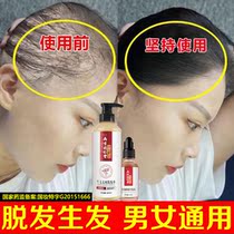 Ginger shampoo anti-exalpable male development hair growth and hair loss severe lady anti-desquiturizing anti-itch control oil