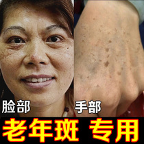  Renhe freckle cream whitening light freckles melasma flagship store age spots hands and face special artifact to go
