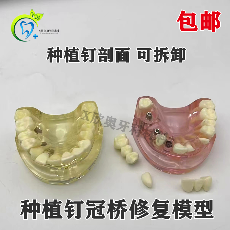 齿科口腔教学模型 种植模型烤瓷连桥种植体修复模型 种植连桥模型