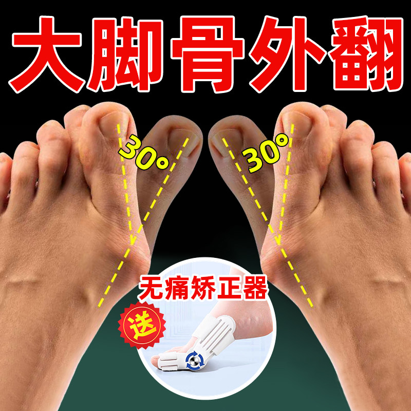 (100% success) Thumb valgus big foot bone corrector female toe overlap special plaster for hallux valgus