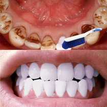 (Watson’s best seller) Teeth whitening tool for both men and women no need to ask anyone to remove yellow teeth remove stone stains tobacco stains and tea stains