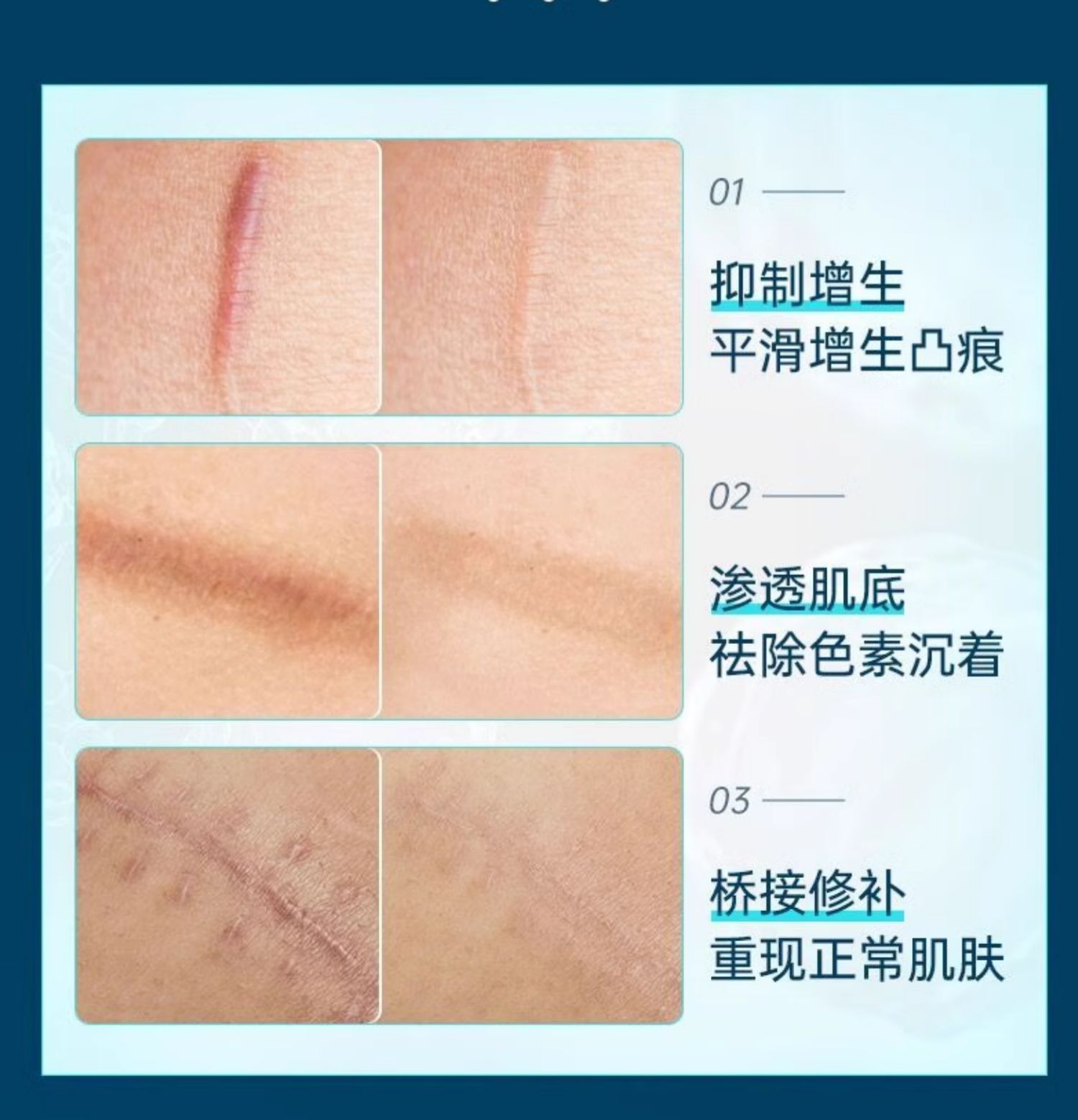 修正 医用硅酮疤痕凝胶  祛疤祛痘印 烧伤烫伤疤痕痘印修复神器  20g/支(小红书种草推荐)