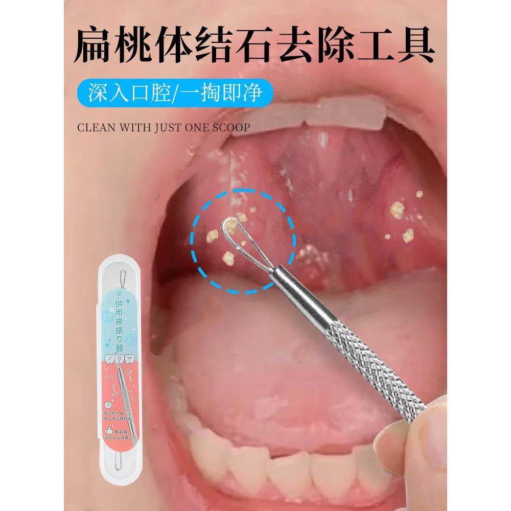 扁桃体结石去除工具取出隐窝神器口腔扁条体扁桃腺扁导体石清理器