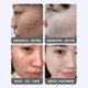 Anti-Acne Cream Official Flagship Store Genuine Anti-Acne and Lightening Acne Pits and Acne Marks Acne Azelaic Acid Anti-Acne Gel