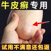 Cattle skin fresh ringworm external use non-specific adult prescription antipruritic ointment ointment special skin Moss disease treatment