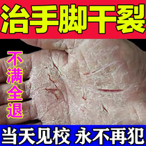 The ointment for the cure (fast healing) of the hands and feet dry cracked feet heel drying rough peeling repair anti-crack cream