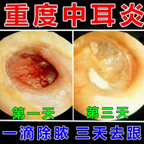 Special medicine for treating otitis media ear pus water to relieve itching and antibacterial anti-inflammatory ear drops for human use pus-absorbing ear cleaning artifact