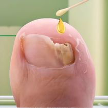 Suitable for those who are impatient (refundable if not purified). Just drop a drop of it to turn bad nails into good ones. Use AJJ to enjoy a good nail life.