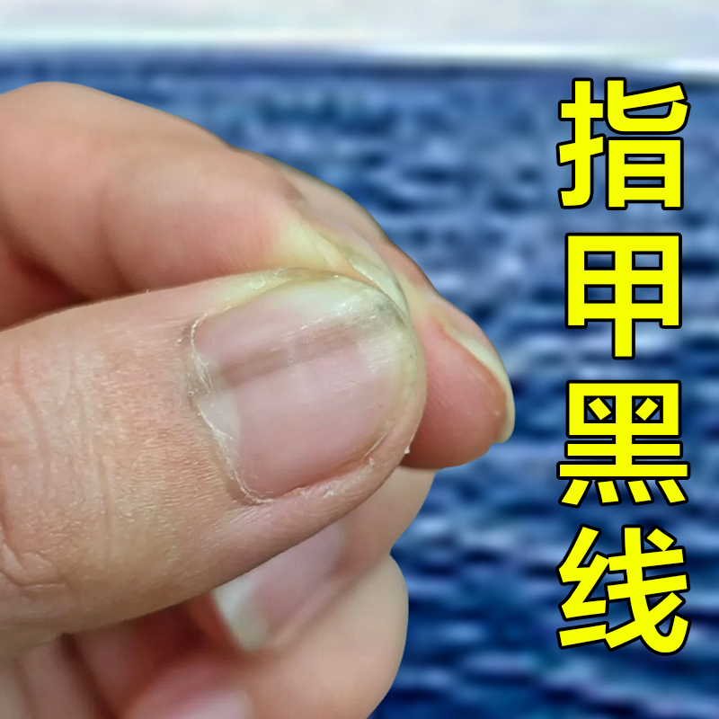 Nails with Black Thread, Nail Moth Mole, Nail Care Solution, Black Thread on Nails, Uneven Nails, Vertical Pattern Black