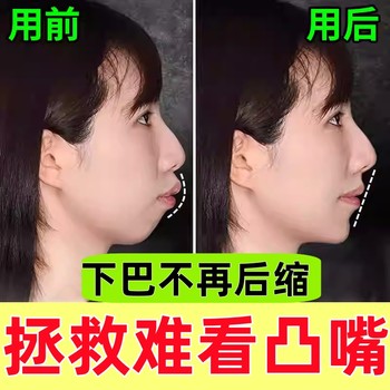 Orthodontic Appliance for Protruding Lips, Retracted Chin, Bone-Based Dental Misalignment, Uneven Teeth, Buck Teeth, and Underbite Traction Device for Adults and Children