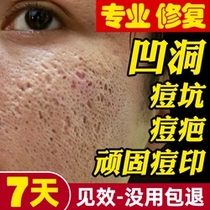 Acne acne pit pit cavity repair male Lady acne scars desalination ointment filling pore water bean regeneration artifact