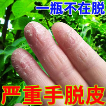 Therapeutic Hand Peeling of Ointment Fungal Infected Hands Finger head hand Goose Palm Dry Cleans to repair Sweat Herpes Cream