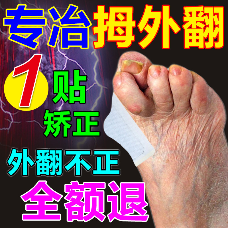 (One sticker correction) thumb valgus correction artifact big foot deformity toe overlapping joint pain plaster sticker