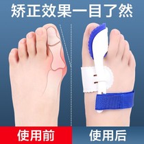 Thumb Valgus correction Thumb valgus correction Thumb valgus correction Thumb valgus correction Thumb valgus correction Thumb valgus correction Thumb valgus correction Thumb valgus correction Thumb valgus correction Thumb valgus