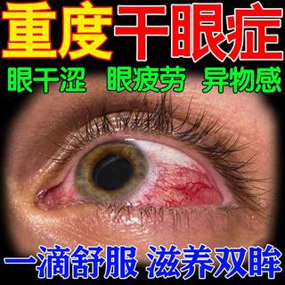 Gotas oftálmicas especiales para ojos secos para aliviar el picor, aliviar la fatiga ocular, sequedad y enrojecimiento spray especial