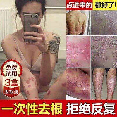 Somi's new urea cutting grass rooting cream Japan vg ointment leather private itching cream vulva itching