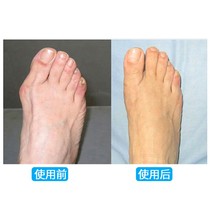 Silicone Gel Big Toe Thumb Valgus Straightener Large Footed Bones Socks Toe Corrective Toe Instrumental Men Can Wear Shoes