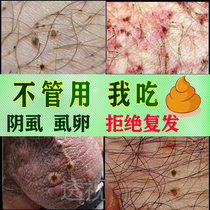Smelting pubic lice medicine pubic lice sweep away light lice Lijing Baibu tincture spray male and female private parts itching to remove pubic lice