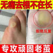 Removal of foot calluses and calluses softener on the little toe to remove the cocoon root to go to the foot pad and hard skin special artifact