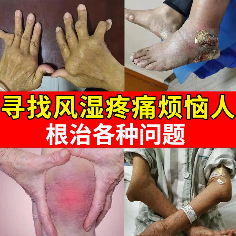 Rheumatism root cure king new version of gout special medicine joint pain uric acid high rheumatism external medicine rheumatism special medicine L