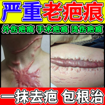 去除增生疤痕疙瘩凸起特效修复烧烫伤刀疤痒瘢痕软化手术缝针药膏