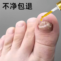 (Tongrentang hot sale) One drop of it inhibits bacteria without removing nails and removes 99% of gray potash fungi. Return guarantee if invalid.