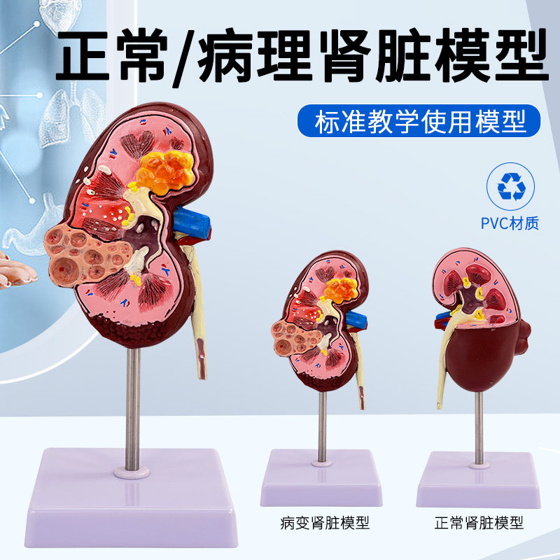 人体肾解剖模型 病变肾脏模型 病态肾脏 人体内脏器官解剖模型