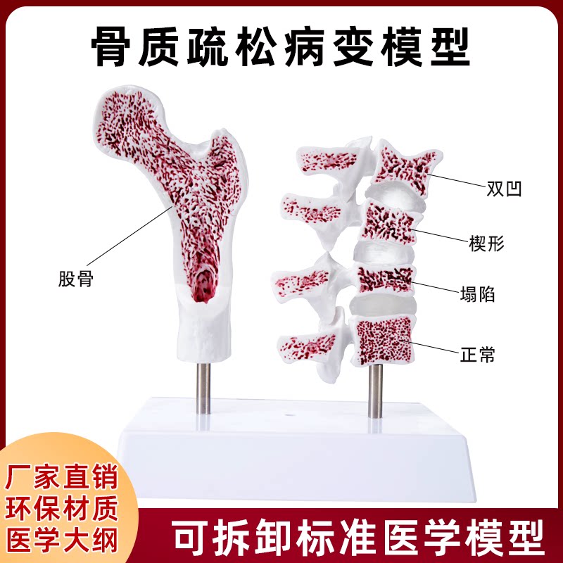 仿真人体骨质疏松骨骼股骨头脊椎双凹塌陷楔形病理变正常教学模型
