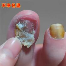 Tongrentang sells for RMB 100000 non-guaranteed no repair (one drop) painless removal of broken potassium from hands and toes gray potassium gram