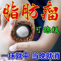 Fatty aneurysm removal theoblastoma paste treatment for elimination of subcutaneous fat hard lump multiple cysts Traditional Chinese medicine dissipation cream