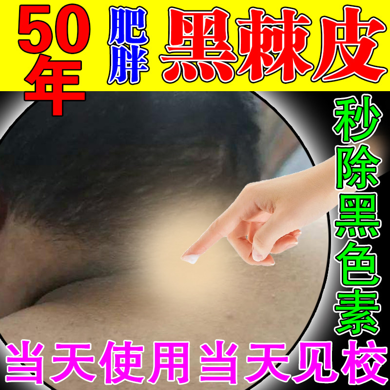 Remove acanthosis nigricans, lighten neck melanin precipitation, remove scar prints, neck joints, armpits, private parts, whitening artifact