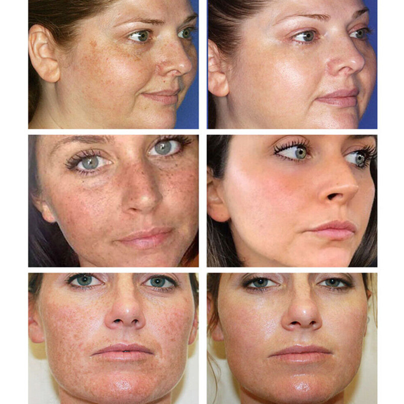 can glutathione remove freckles 30ML Glutathione Whitening Freckles Serum Remove Dark Spots评价- 淘宝网