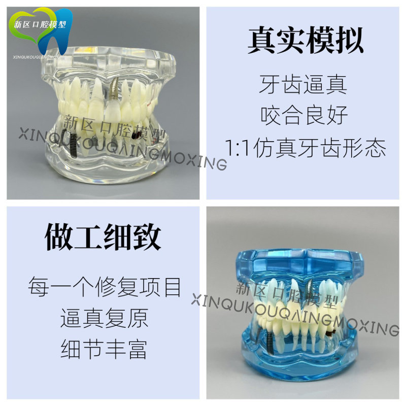 牙科材料 连桥修复体模型 病理牙模型 可拆卸活动牙种植体 包邮