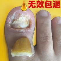 (Tongrentang hot sale) Painless replacement of potassium enjoy a good nail life turn bad nails into good ones drop by drop