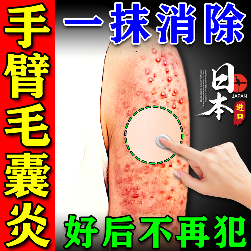 Folliculitis on the Arms, Pimples on the Arms, Acne on the Back and Chest, Special Medicine for Removing Mites and Treating Acne and Folliculitis Folliculitis on the Arms, Pimples on the Arms, Acne on the Back and Chest, Special Medicine for Removing Mites and Treating Acne and Folliculitis