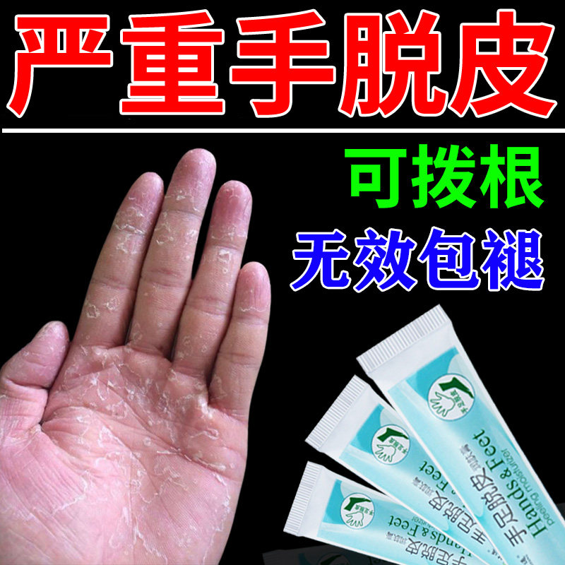 Itching, peeling, dry and cracked hand gas ointment, palm peeling, dryness, seasonal repeated about small blisters on hands, antipruritic ointment