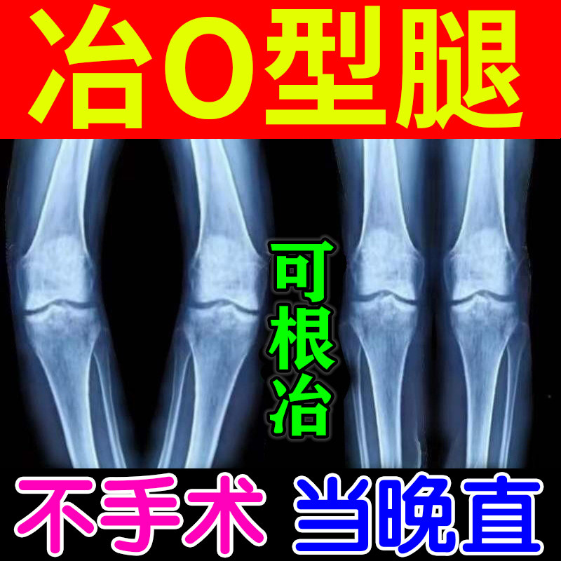 Calf valgus correction O-shaped leg correction artifact unisex O-shaped leg X-shaped leg ring leg corrector paste