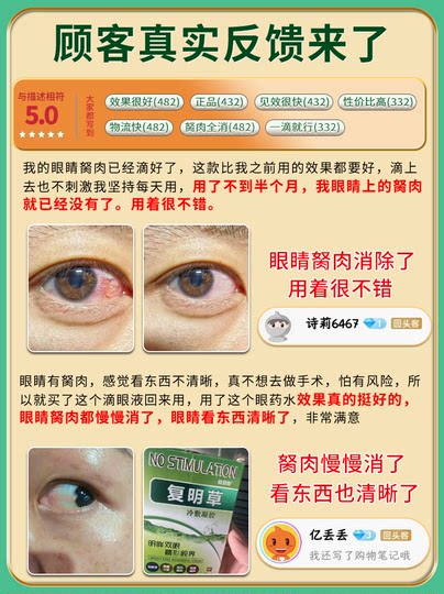 Gotas para los ojos para eliminar pólipos oculares, pterigión largo, visión borrosa, sensación de cuerpo extraño, gotas para los ojos para eliminar los filamentos rojos de la sangre.