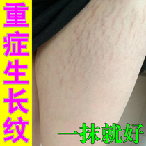 Dilute lines and repair cream to eliminate growth lines on thighs students teenagers belly and butt to remove obesity lines and repair cream