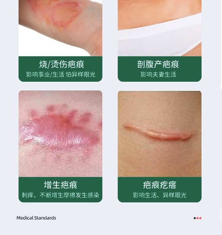 Убрать растяжки массажер 【日本爆款热卖】日系疤痕滚珠修复剖腹产增生凹凸疤痕全身 OTHER