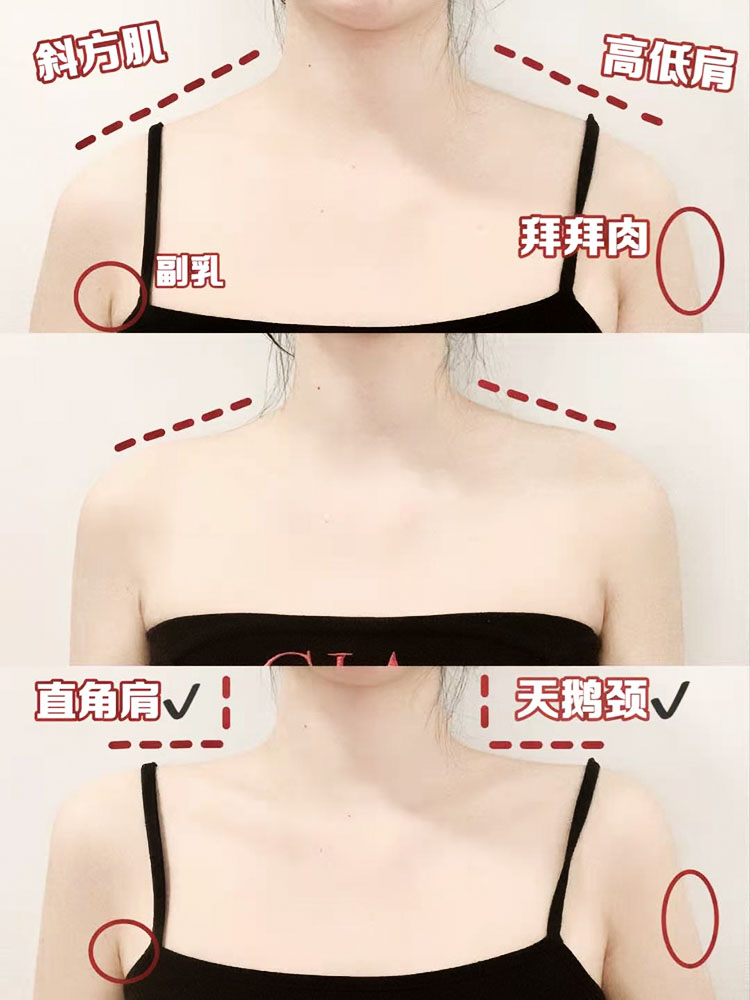 (Jiaqi Recommended) Beauty Shoulder God sticks out goddess's right-angle shoulder to moisture away from thick shoulder-to-shoulder Ashoulder sticker