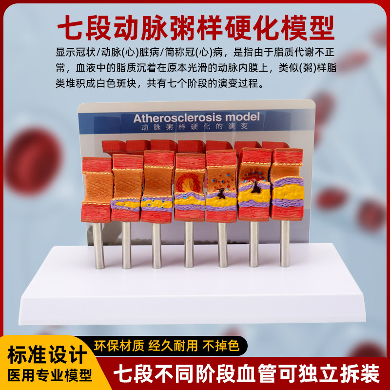 人体心脑血管动脉粥样硬化堵塞模型血栓血液脂肪病理解剖医学教具