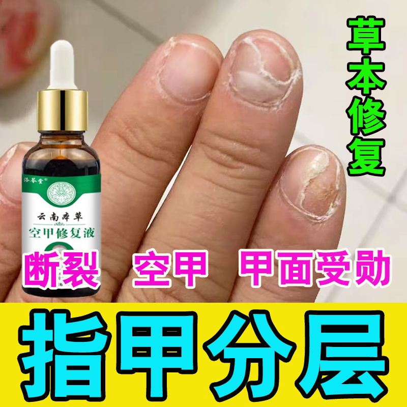 Nail Layering, Cracking, and Breakage Repair Growth Solution; Nail Surface Damage, Unevenness, Thin and Brittle Nails Growth Solution