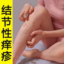 Knots Itch Rash Cream to Goose Recalcitrant Chronic Itch Rash Knots Skin Disease Adult Child Generic