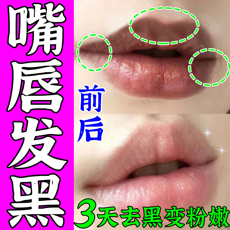 Darken lips, dilute lip color, lip lines, remove melanin, lip oil, remove dead skin, improve black lips and chapped lips