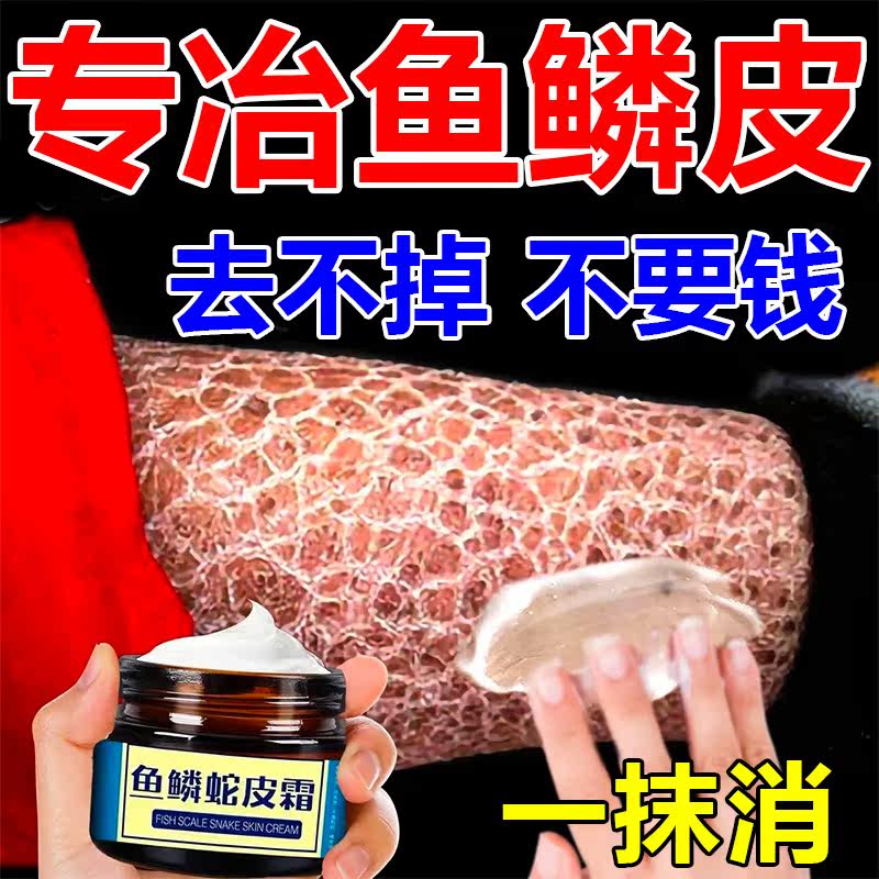 Medicine to remove snake skin fish scales and leg diseases