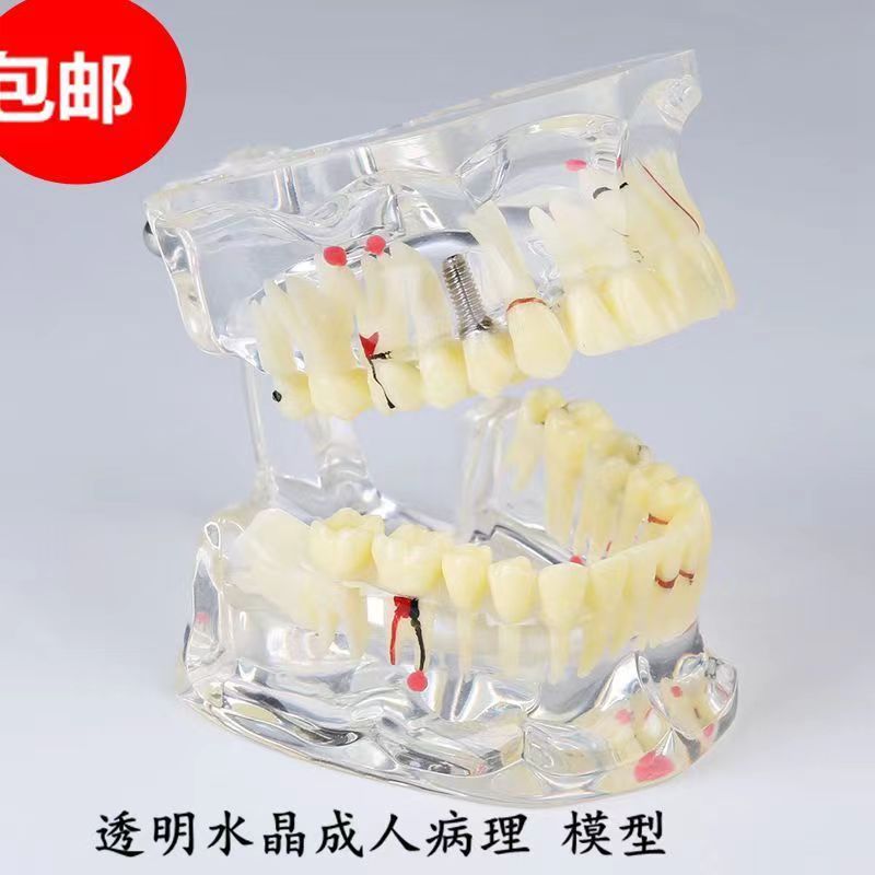 牙科口腔教学 成人病理模型 水晶透明 标准 缺牙 医患沟通 包邮