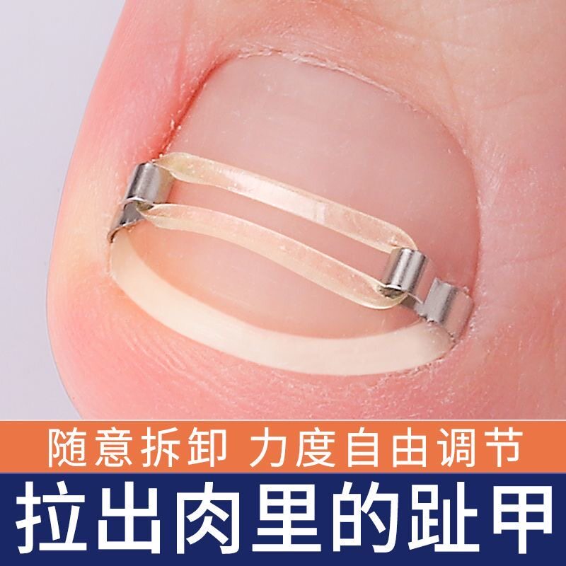 正甲扣嵌甲甲沟矫正器贴脚趾指甲长肉里卷甲专用修脚刀套装神器炎