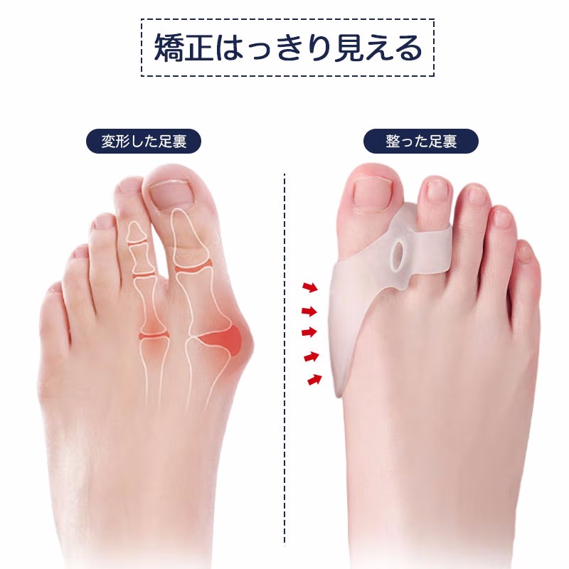 日本脚趾拇指外翻矫正器可穿鞋修正大母外翻分趾隔离器男女趾头纠