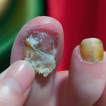 Tong Ren Tang hot sale (no guarantee or repair). Just a drop of potassium can turn bad nails into good ones grow new nails inhibit bacteria and not remove nails.